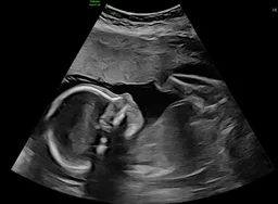 ultrasound image